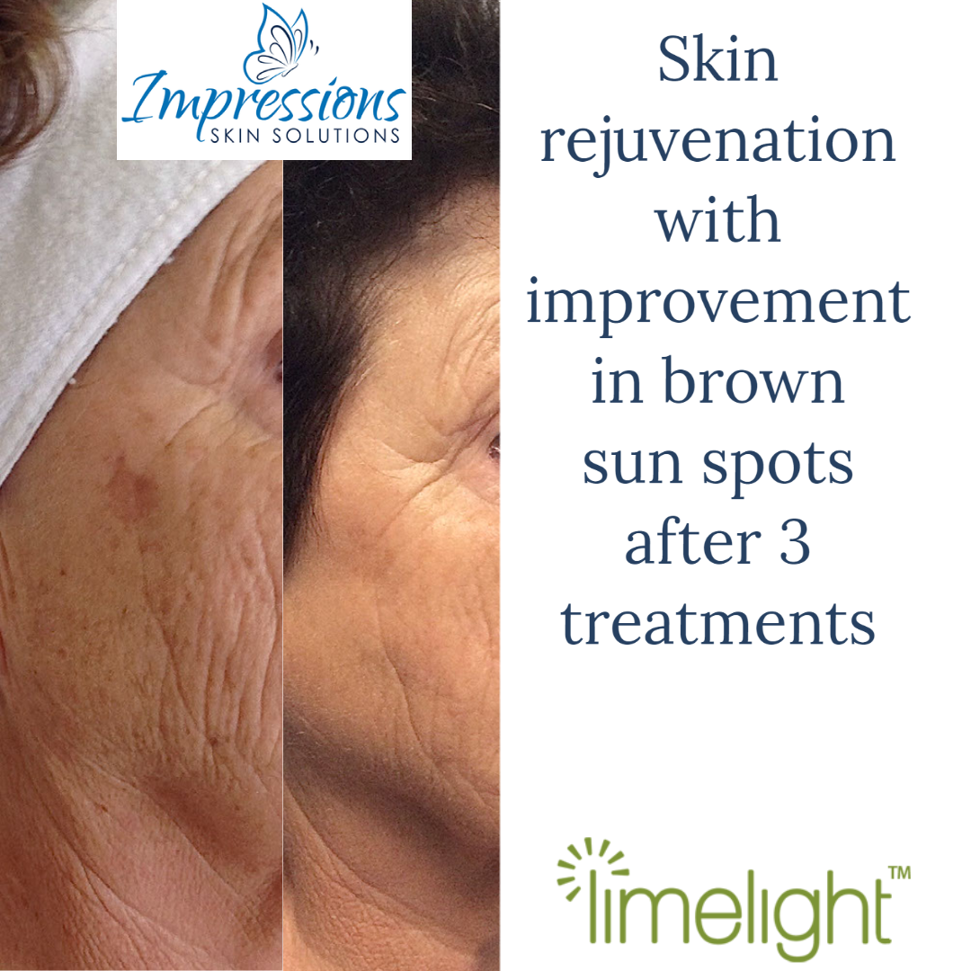 Hyperpigmentation in in Hendersonville, TN | Impressions Skin Solutions