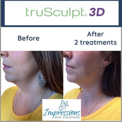 truSculpt-after-2-treatments